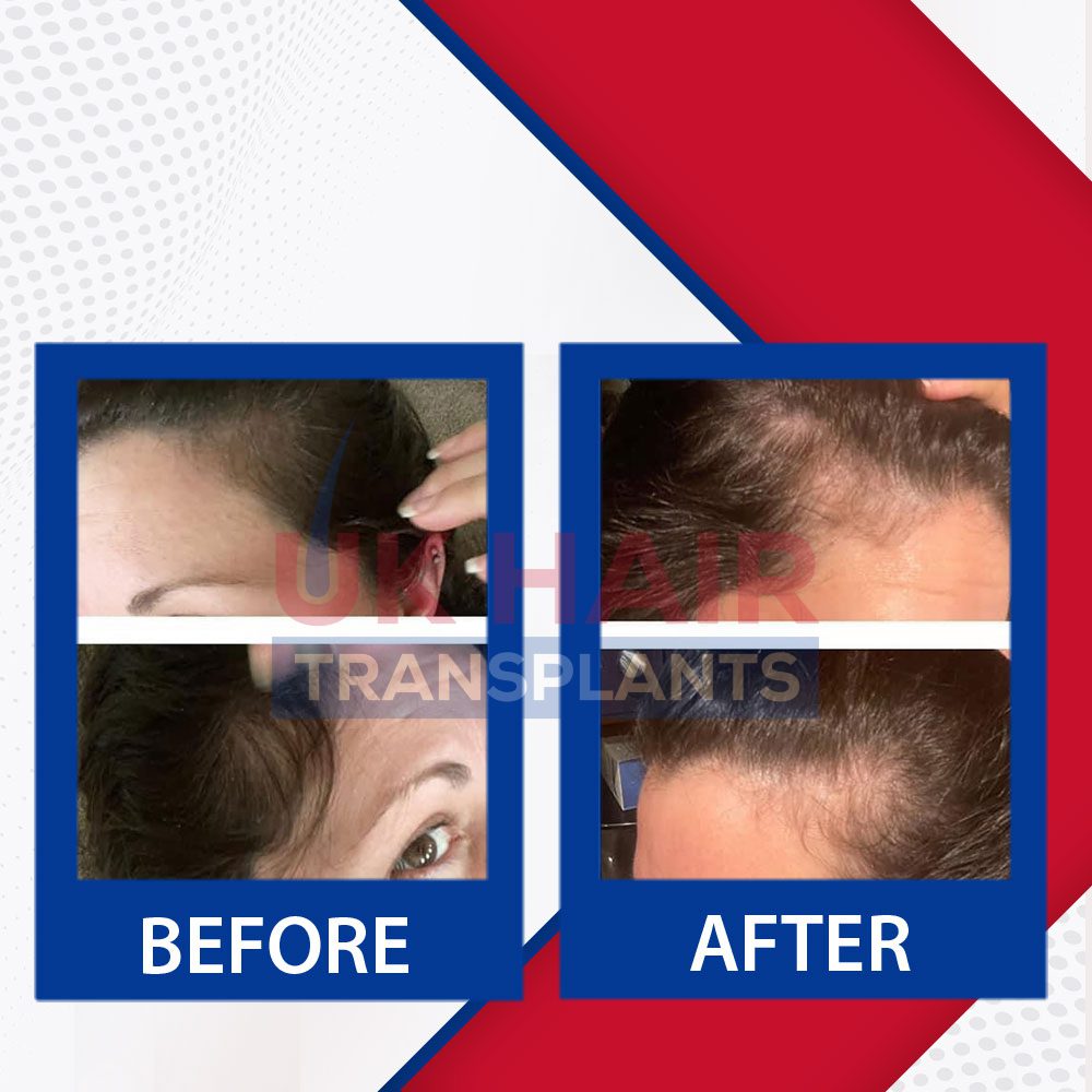 https://uk-hairtransplants.com/wp-content/uploads/2023/02/Before-After-Banner-03.jpg