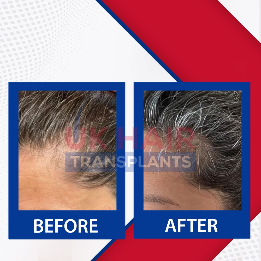 https://uk-hairtransplants.com/wp-content/uploads/2023/02/Before-After-Banner-05.jpg