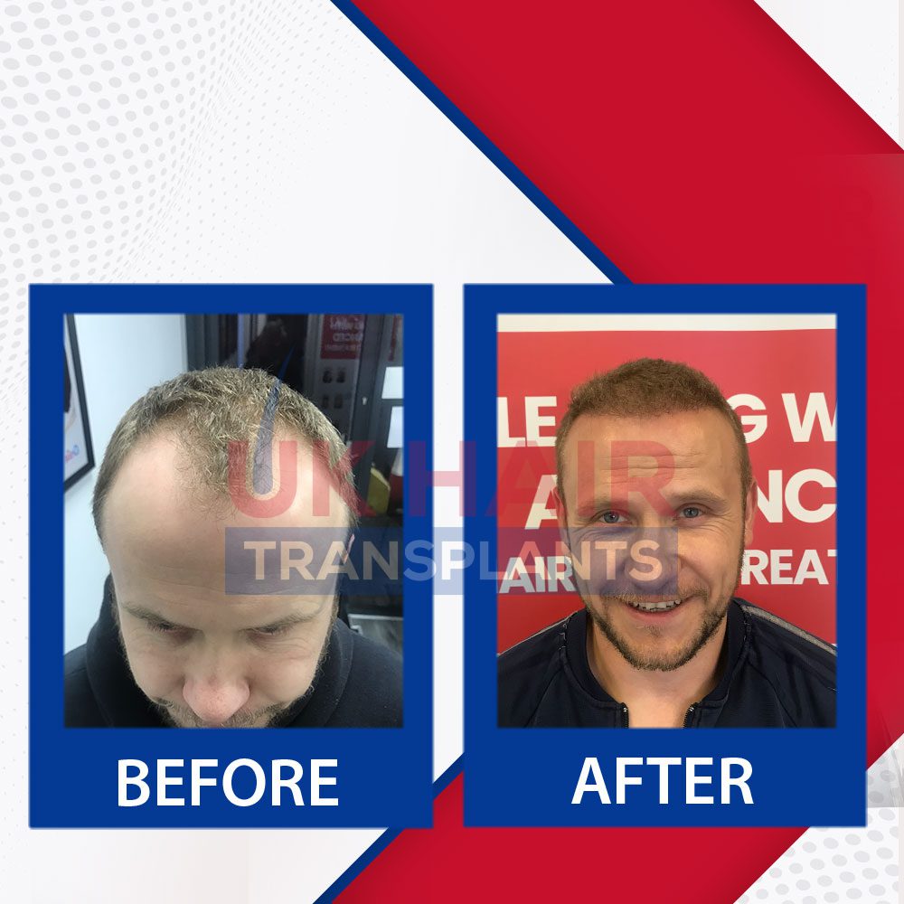https://uk-hairtransplants.com/wp-content/uploads/2023/02/Before-After-Banner-07.jpg