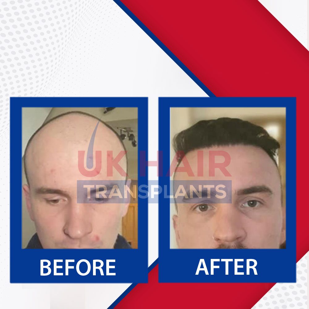 https://uk-hairtransplants.com/wp-content/uploads/2023/02/Before-After-Banner-08.jpg