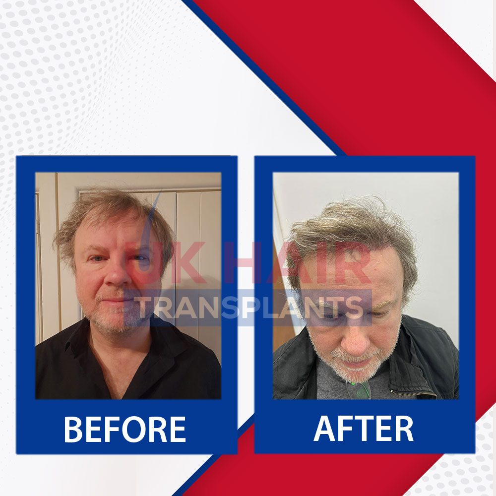 https://uk-hairtransplants.com/wp-content/uploads/2023/02/Before-After-Banner-09-2.jpg