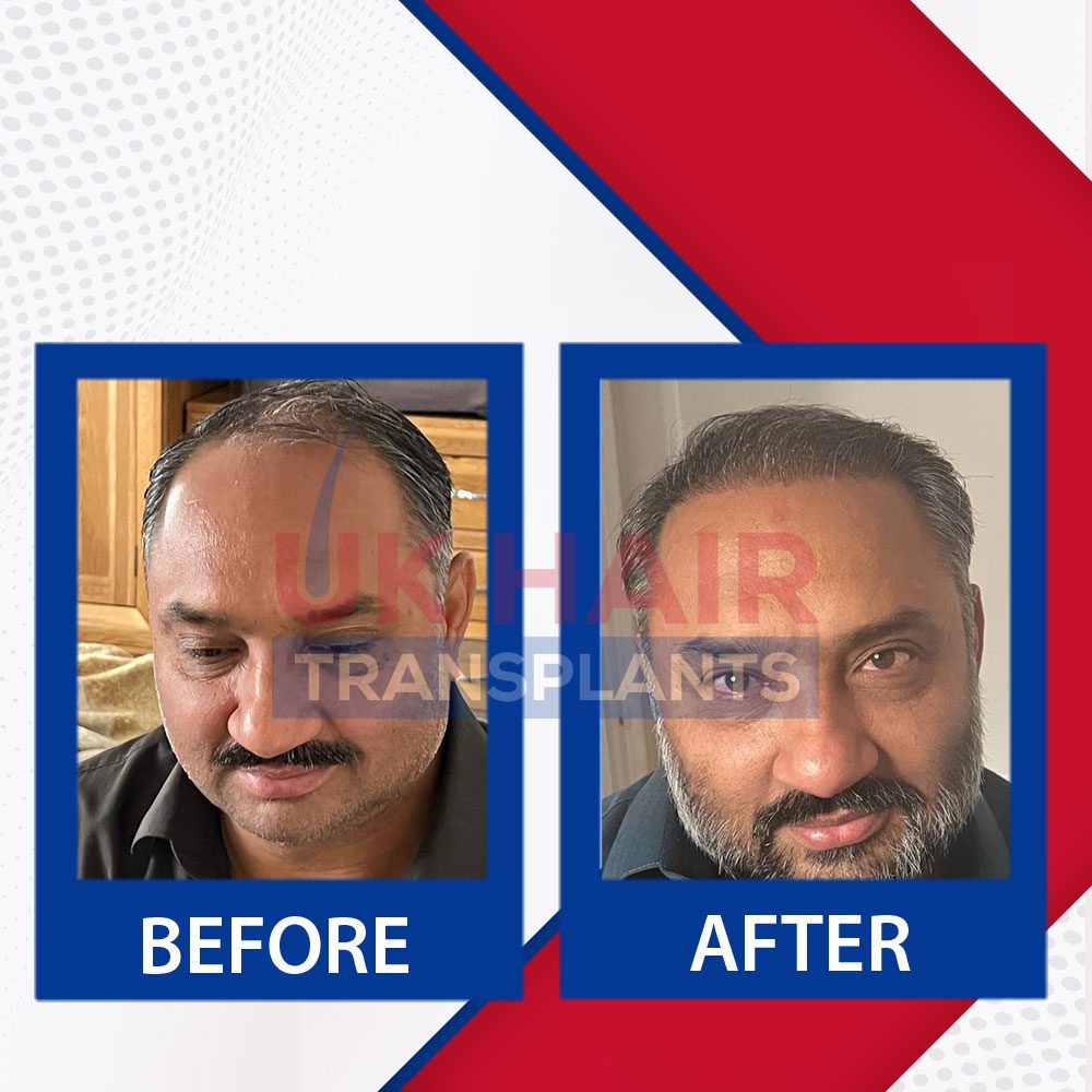 https://uk-hairtransplants.com/wp-content/uploads/2023/02/Before-After-Banner.jpg