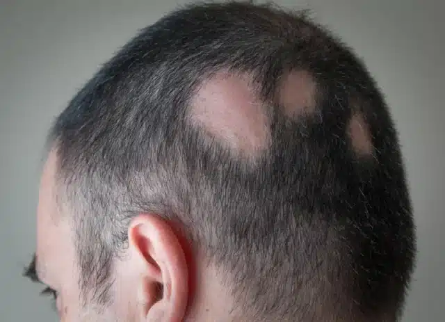 A close-up of a person's head with patchy hair loss due to alopecia is visible on the scalp, resulting in several bald spots. The background is blurred and neutral-colored, drawing attention to the condition's impact on the scalp.