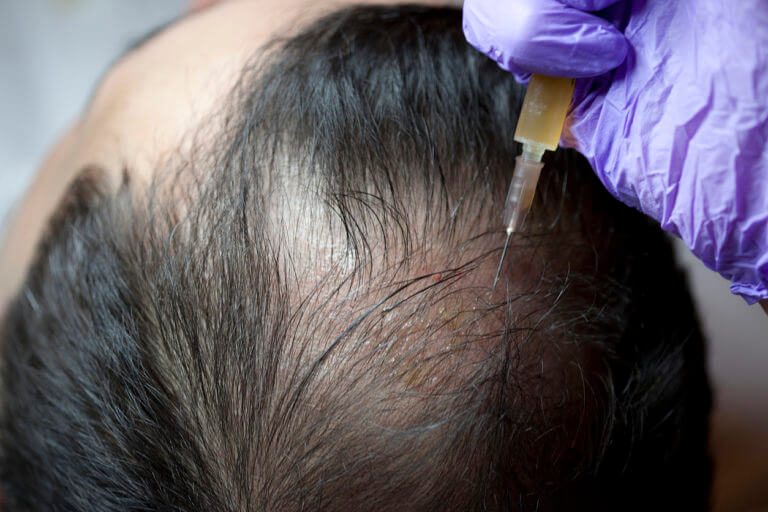 PRP Hair Loss