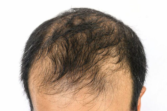 Close-up of the top of a man's head clearly highlighting his receding hairline and thinning hair against a white background.