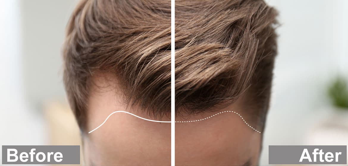 A split image showcases a man's hair transformation, highlighting a mature hairline's evolution. The left side reveals thinning strands, while the right displays fuller, thicker locks. Labels "Before" and "After" adorn the bottom.