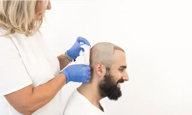 cost hair transplant.webp