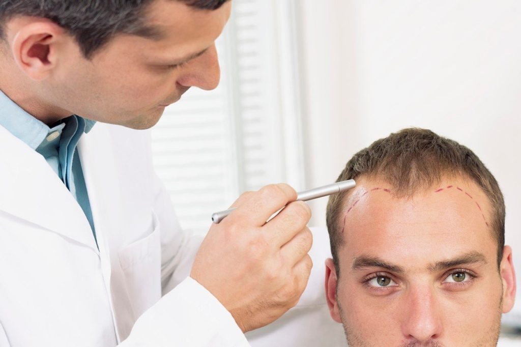 A doctor in a white coat uses a pen to mark the hairline on a man's scalp, addressing his hair loss. The man is seated, looking slightly upwards, while the doctor focuses intently on the markings.