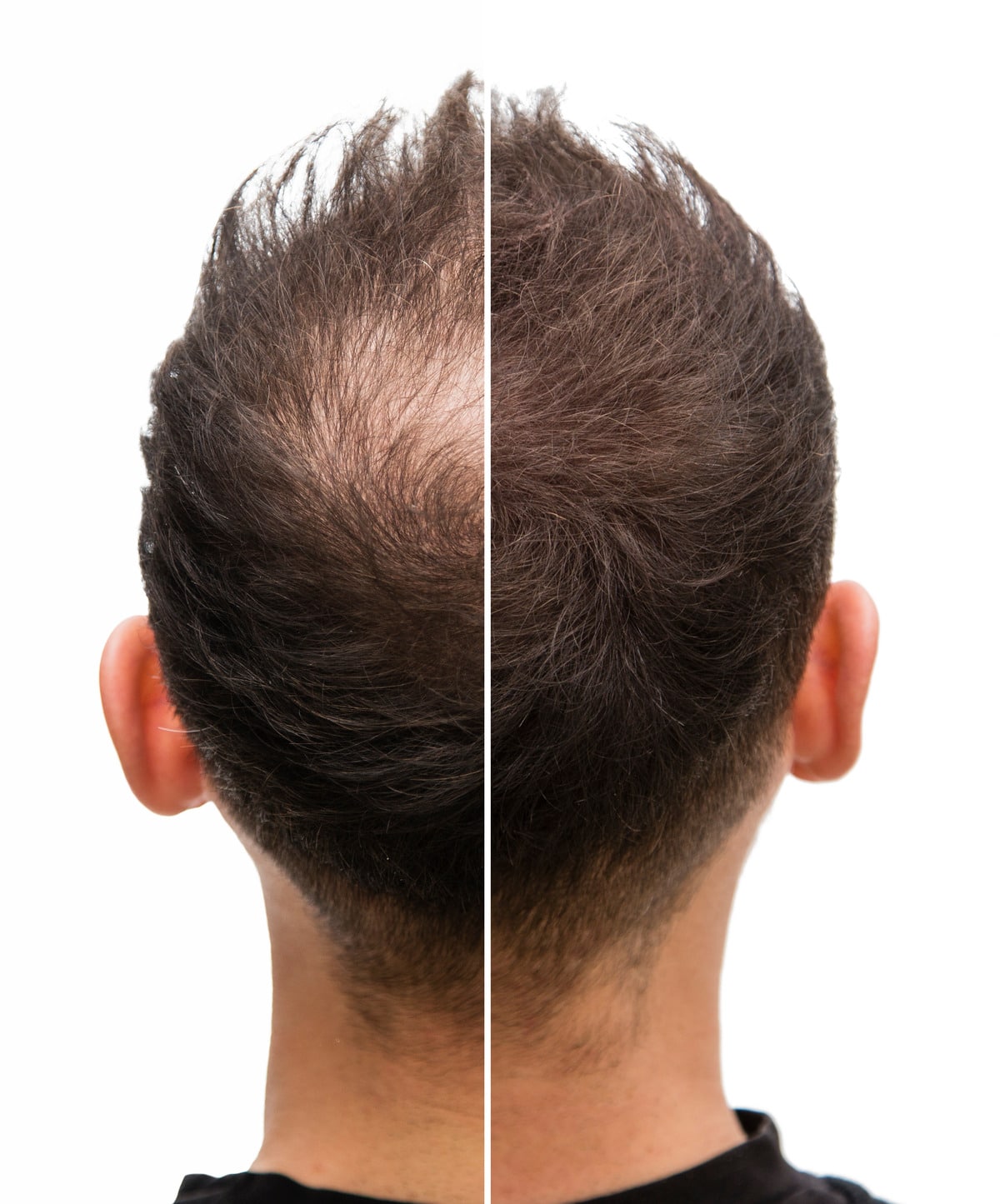 A split image showing the back of a man's head: the left side depicts thinning hair and baldness, while the right side shows thick, full hair. The background is white.