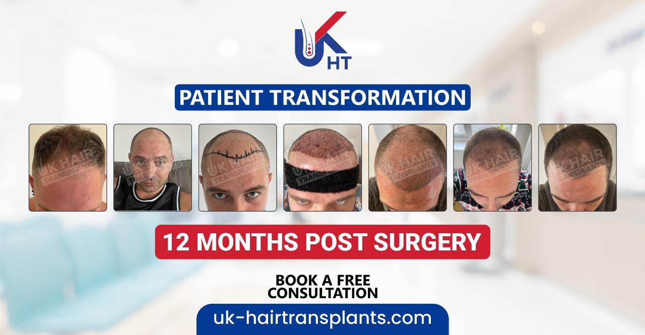 A series of seven photos shows a man's hair transplant progress from before surgery to 12 months after, highlighting significant hair growth and transformation. The text promotes UK Hair Transplants and offers a free consultation.